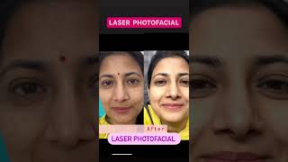 Skin and Hair Treatment/ Acne/AcneScars /Hyperpigmentation / Hair Loss /Alopecia. By Dr Randhir Bhou