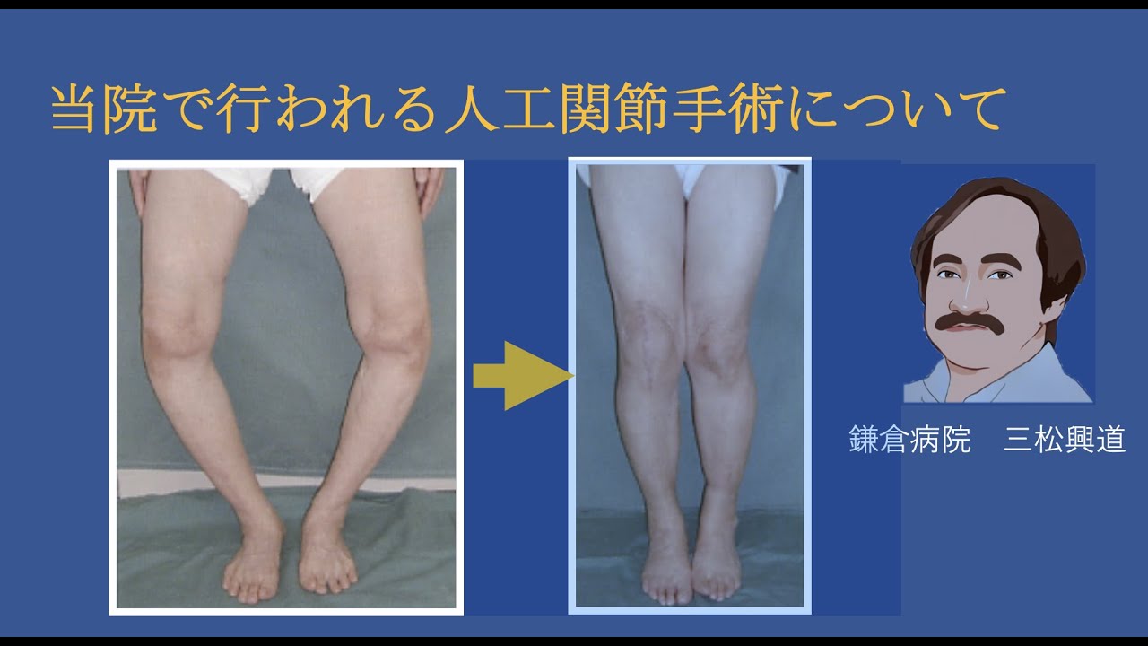 人工関節（膝関節）の手術について（院長 三松興道） 一般財団法人鎌倉