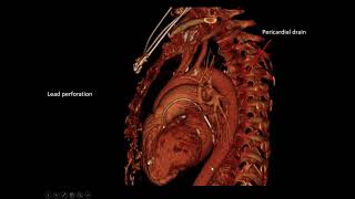 Cardiac Devices: What Is It and Where Should It Be? screenshot 5