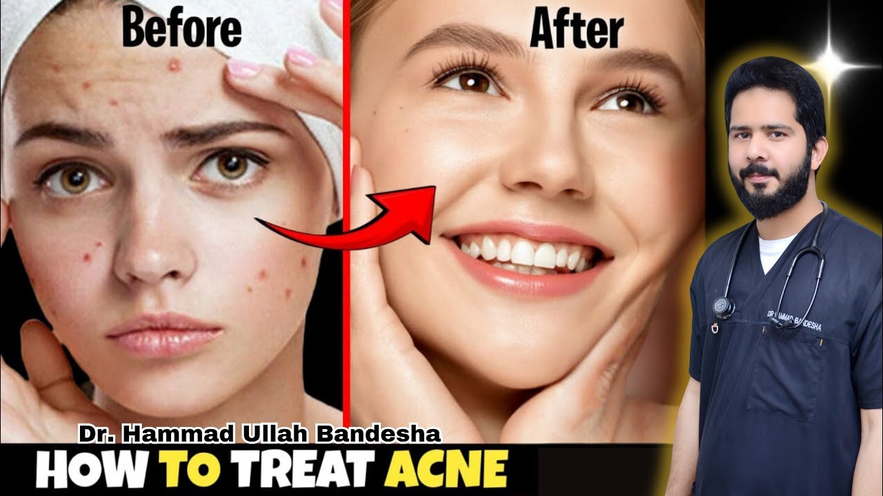How to get rid of Acne Naturally || Dr. Bandesha || Acne. - YouTube
