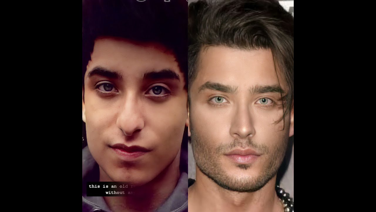 TONI MAHFUD SURGERY before & after @ToniMahfud - YouTube.