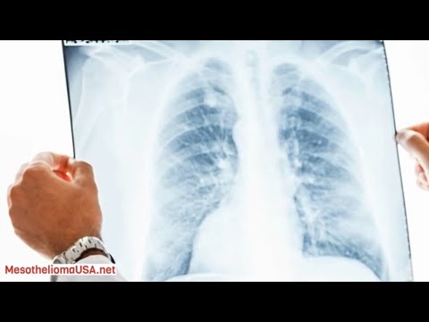 Video: A shkakton asbestoza kancer të mushkërive?