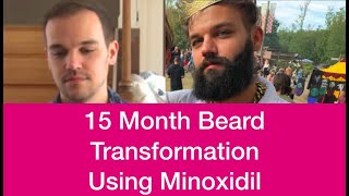 15 Month Minoxidil Beard Journey - EXPLOSIVE Gains!