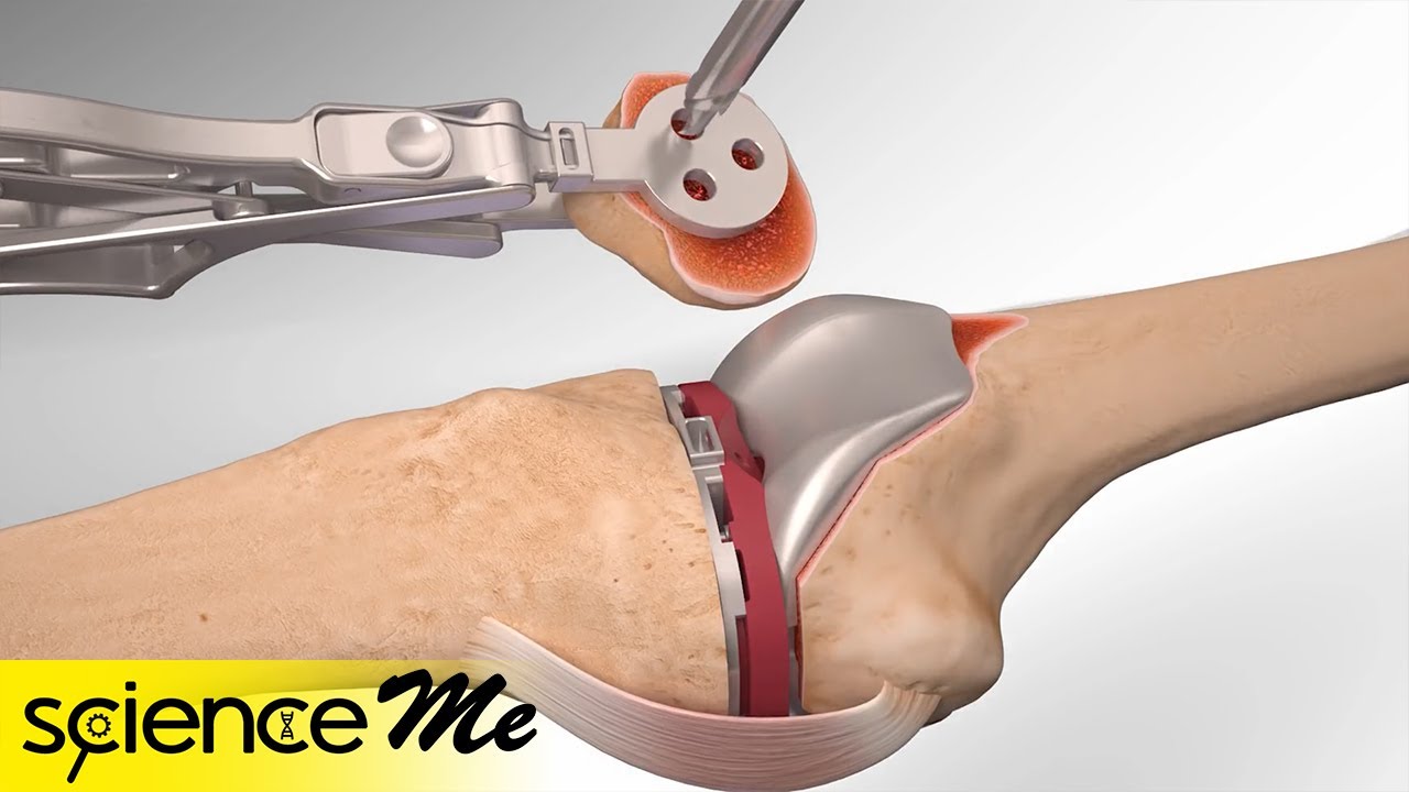 استبدال الركبة بشكل كامل | عملية مفصل الركبة الصناعي