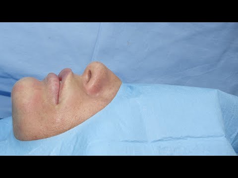 Produženje brade masnim tkivom i rezultat nakon 5 godina / Chin extension with fat grafting