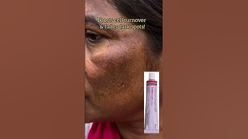 Tretinoin 0.05% Cream | Clear Skin Secret! & Melasma #Tretinoin #Pigmentation #Melasma