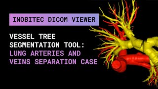 New version of the vessel tree segmentation tool: lung arteries and veins separation case