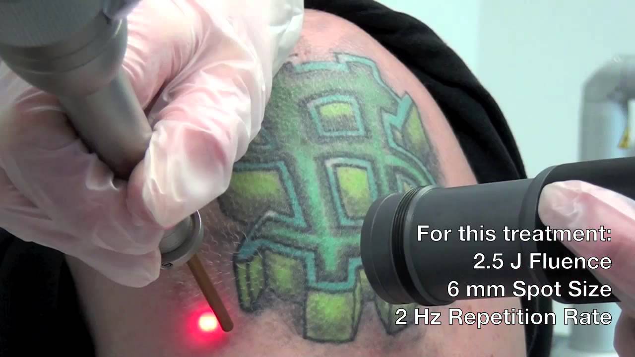 Q Switched Laser Treatment Tattoo Removal at Viva Aesthetic Clinic