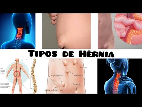 Vídeo: Imagens De Hérnia De 6 Tipos Comuns