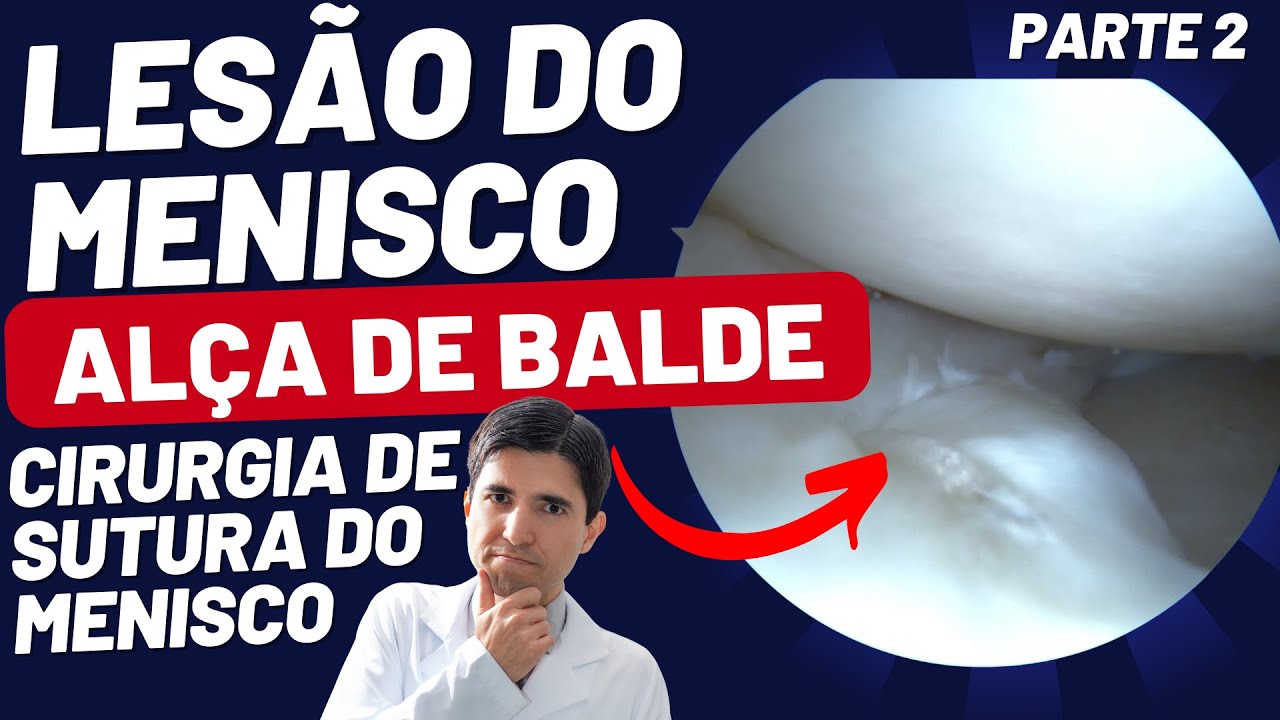 CIRURGIA DE SUTURA DO MENISCO LESÃO EM ALÇA DE BALDE VIDEOARTROSCOPIA ...