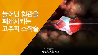 늘어난 혈관을 폐쇄시키는 고주파 소작술 - (20180829_660회 방송) 내 다리가 아픈 이유, 종아리를 주목하라
