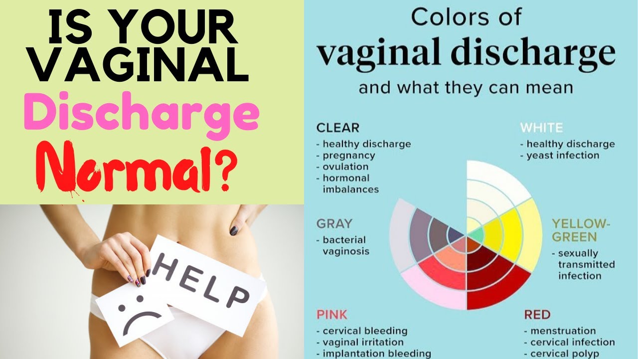 Vaginal Discharge Types Treatment White Vaginal Discharge Explained Sexiz Pix
