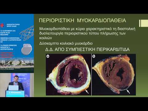 Σ.Μπακαλιός  | Αξιολόγηση του καρδιακού επιπωματισμού της συμπιεστικής περικαρδίτιδας και της περ...