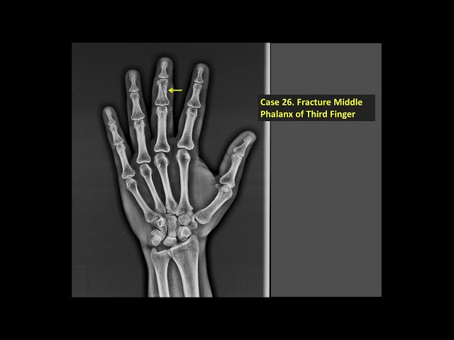 X-Ray Case 26 - Fracture Middle Phalanx of Third Finger