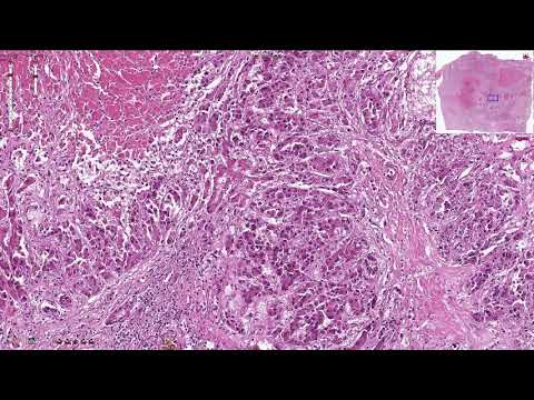 Video: Molekylær Målrettet Og Immunkontrollterapi For Avansert Hepatocellulært Karsinom