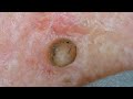 0303 keratin plug removal nose