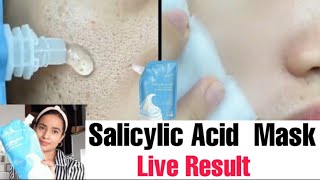 Salicylic Acid Ice Cream  Mask Remove|open porse |Acne | Pimples| Black Heads | Honest Review + Demo screenshot 3