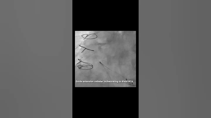 Complex PCI: Heavily calcified RCA using rotablation and guide extension catheter #cathlab