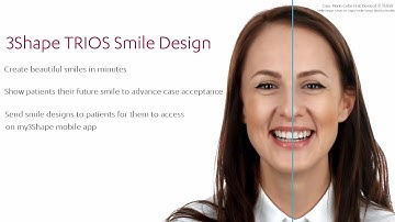 3Shape TRIOS Smile Design – simple workflow for clinic