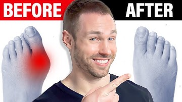 How to Fix Bunions Naturally [No Surgery Needed]