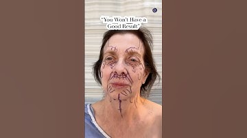 Natural Results| Facelift 2 Months Post-Op| Before and After