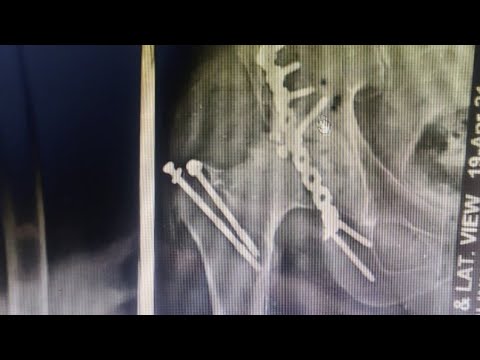 Hip Arthritis after Fracture Acetabulum - Part 1