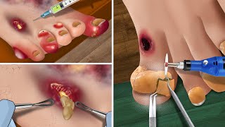 Asmr The Best Treatment For Foot Diseases Ingrown Nails Purulent Swollen Toes