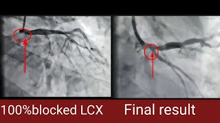 Heart attack with 100% block in LCX II LCX opened with one stent II Angioplasty of LCX