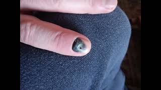 20 week time lapse of finger nail falling off.