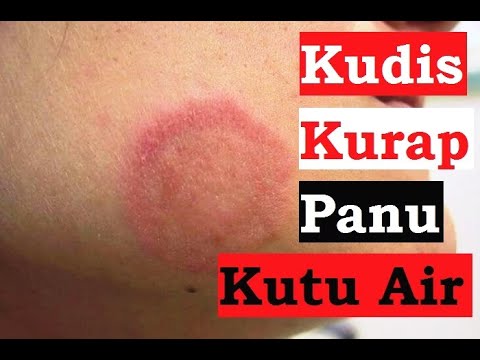 Video: Fusiderm - Petunjuk Penggunaan, Harga, Ulasan, Krim, Salep, Gel