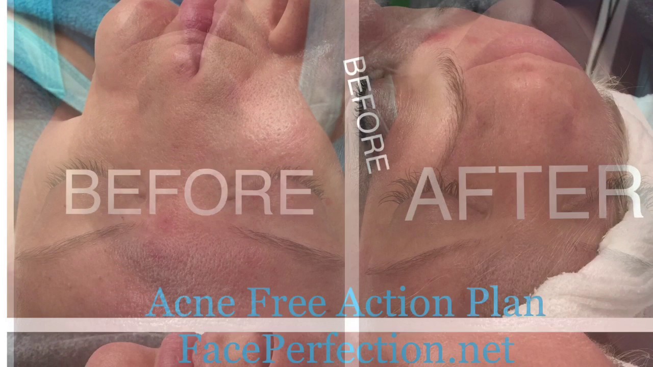 Acne Free Action Plan