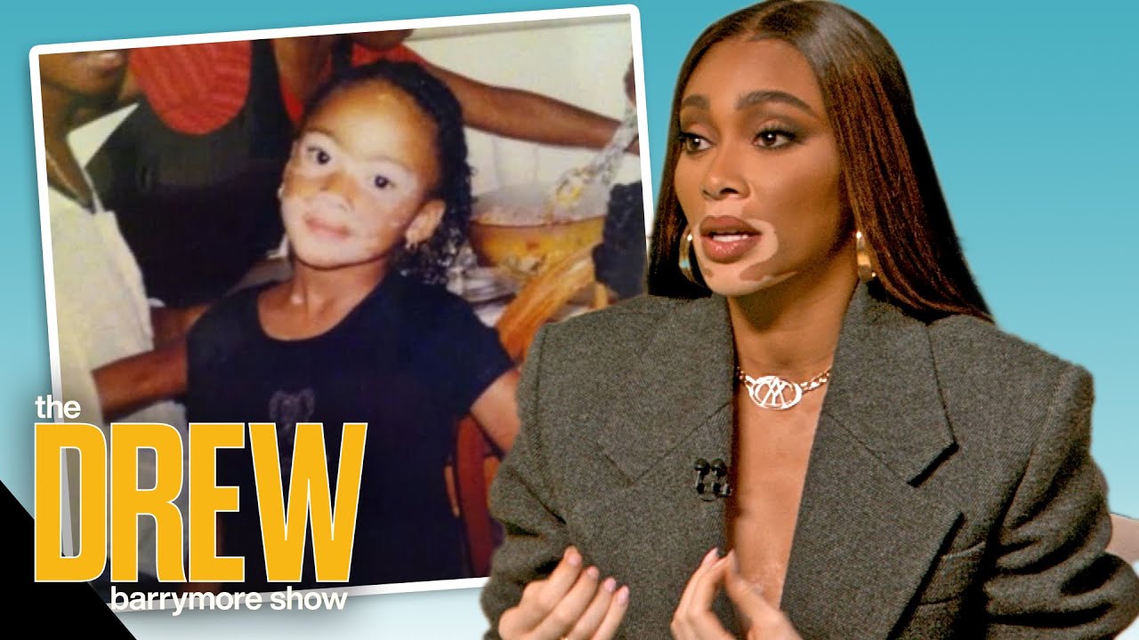 Winnie Harlow Credits Her Family For Normalizing Her Vitiligo