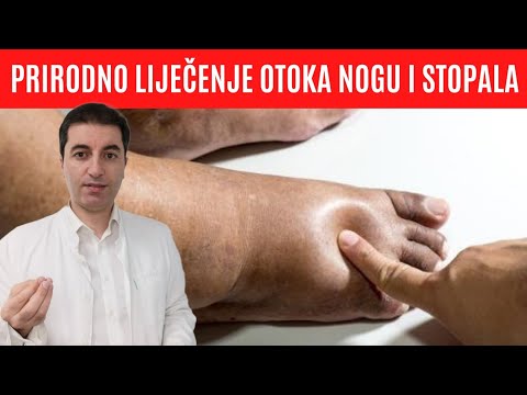 Video: Srčani Edem Nogu, Ruku, Lica: Simptomi I Liječenje