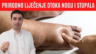 Kako izlije?iti OTE?ENOST( EDEM) nogu,stopala ili nonih zglobova?