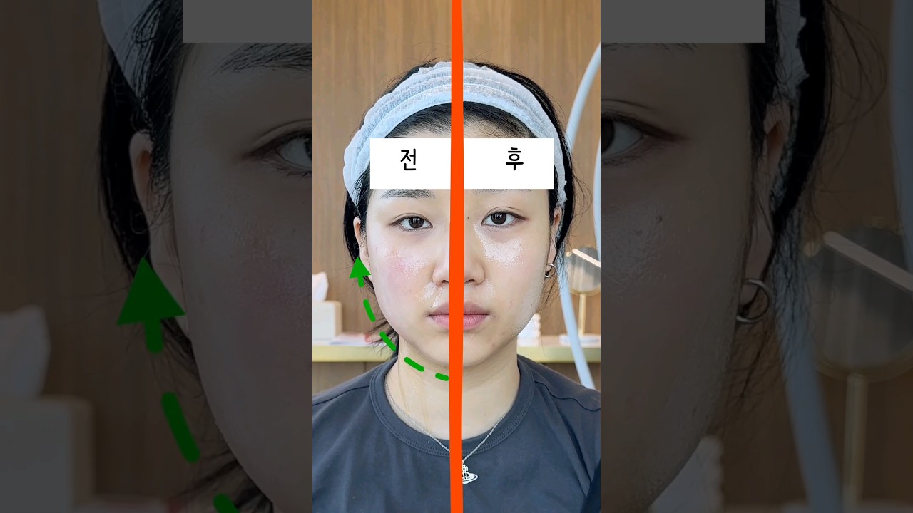 [Риенжанг Гоо сайхны мэс заслын эмнэлэг] Онда лифтинг сэтгэгдэл #Ондалифтинг #Ондалифтингсэтгэгдэл #Арьсарчилгаа #Давхарэрүү #Нүүр #Үрчлээ