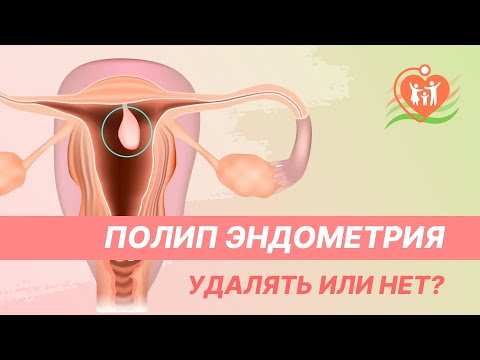 🔴  Полип эндометрия. Удалять или нет?