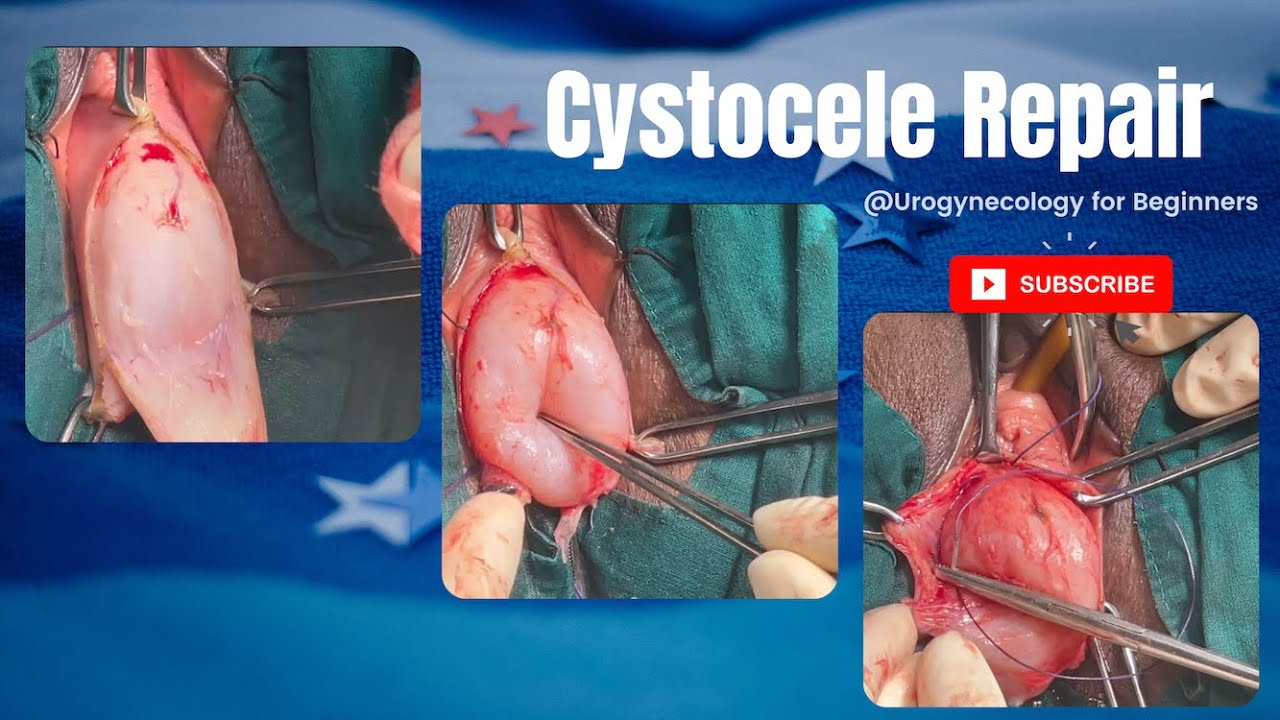 Anterior vaginal prolapse (cystocele) - Diagnosis and treatment