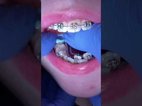 Orthodontic appliances 11