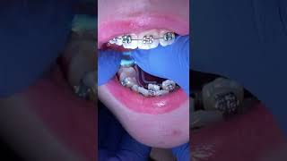Orthodontic appliances 11 year old patient - RPE Upper and Lower - Tooth Time Family Dentistry