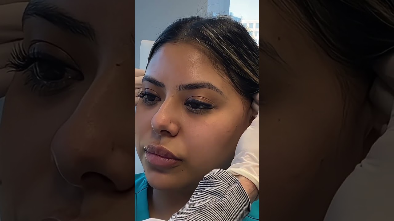 Banner for Have you seen lifting like this before? #cosmetic #injections #sandiego