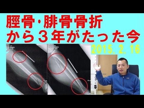 脛骨 腓骨骨折から３年経過した今の状況 Youtube