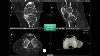 AlgoSurg's #ai and #cloud solution for #robotics and #3dprinting surgical solutions (Knee Demo)