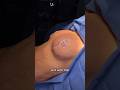 Want a breast enhancement without implants? Follow along as we do a lift with fat grafting 🍒