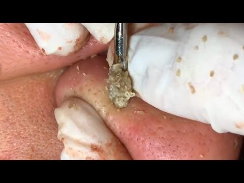 How To Remove Blackheads And Whiteheads On Nose ✦ Dr Laelia ✦