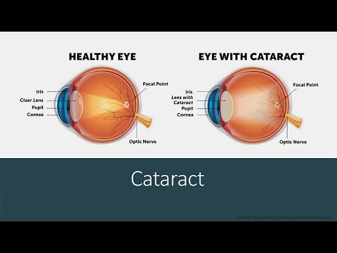 Introduction to Ocular Disease and Cataract Surgery