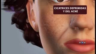 Rellenos Faciales Acido Hialuronico Fotos Explicación y Aplicación
