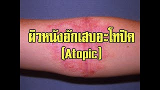 คุยกับ นพ.สมนึก อมรสิริพาณิชย์ เรื่อง ผิวหนังอักเสบอะโทปิค(Atopic)