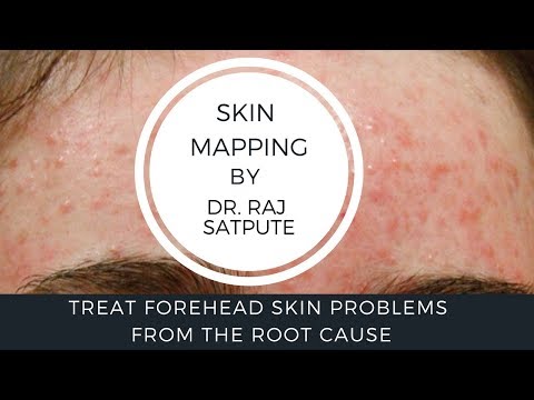 Treat Forehead Acne In One Week | माथे पर दाने और चेहरे पर पिंपल्स बस एक हफ्ते गायब | Acne Mapping