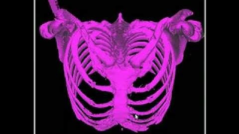 Voxel field polygonization for 3D surface reconstruction (Female Chest)