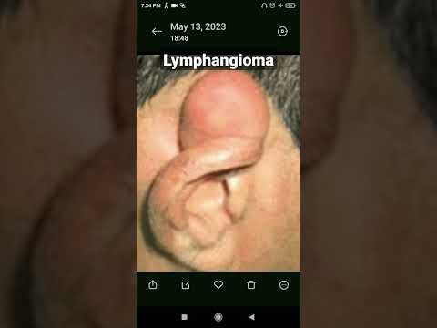 Lymphangioma of the